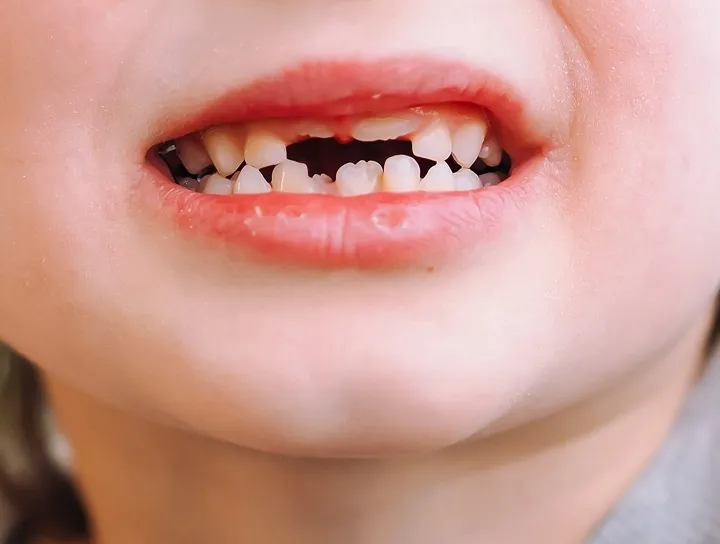 Süt Dişleri Neden Tedavi Edilmelidir?