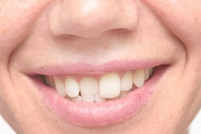 Konya Ortodonti | Konya Yamuk ve Çarpık Diş Tedavisi