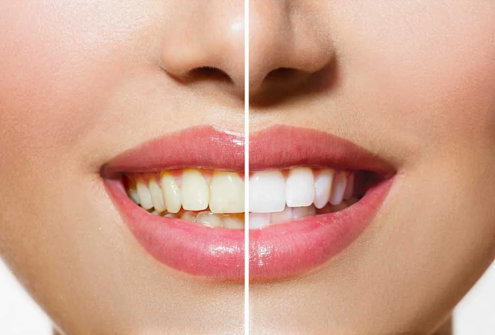 Konya Diş Taşı Temizliği & Konya Diş Beyazlatma & Fiyatları