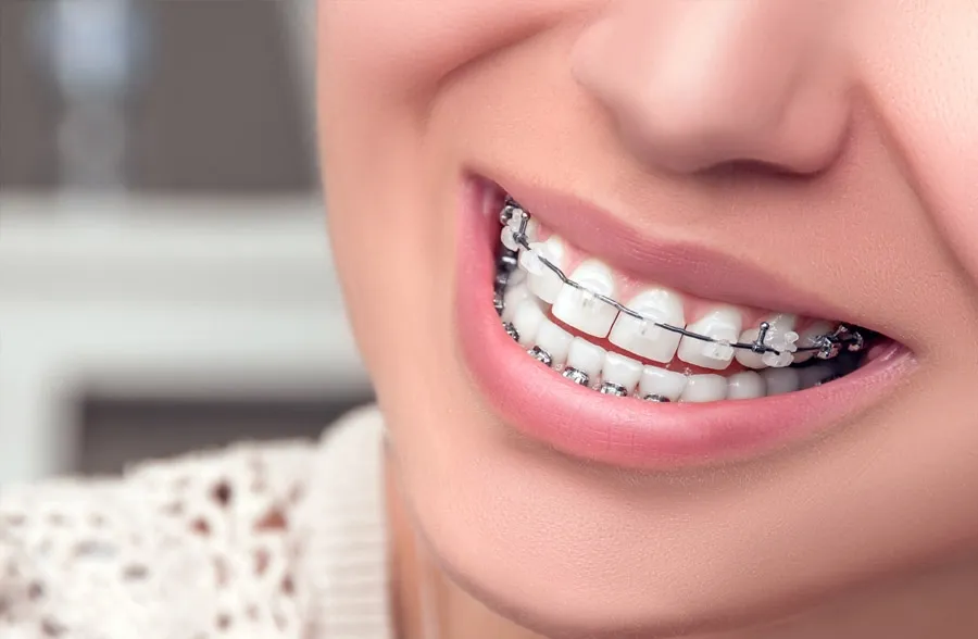 Diş Teli Tedavisinin Aşamaları Nelerdir?